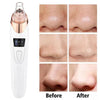 Upgraded Blackhead Remover Vacuum Facial Pore Cleaner Electric Acne Comedone Whitehead Extractor Tool 5 Probes For Women And Men